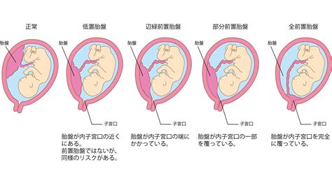 低位胎盤|低置胎盤の症状・原因・対処法 Doctors Me(ドクターズミー)